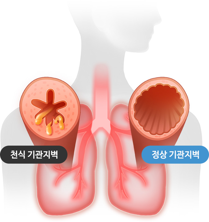 천식 기관지벽 / 정상 기관지벽