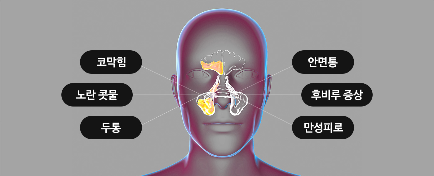 코막힘, 노란 콧물, 두통, 안면통, 후비루 증상, 만성피로