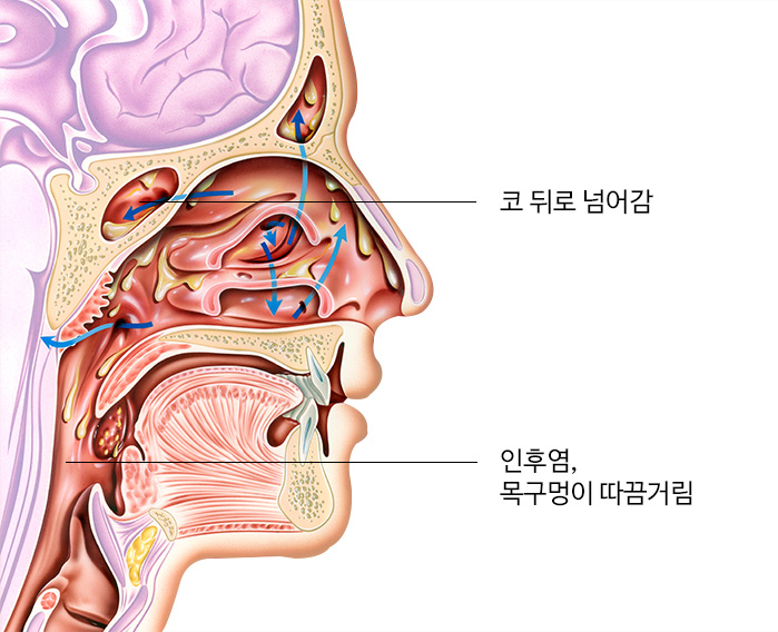 코 뒤로 넘어감, 인후염, 구멍이 따끔거림을 보여주는 모형 이미지